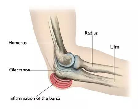 What Is Elbow Replacement Surgery ?